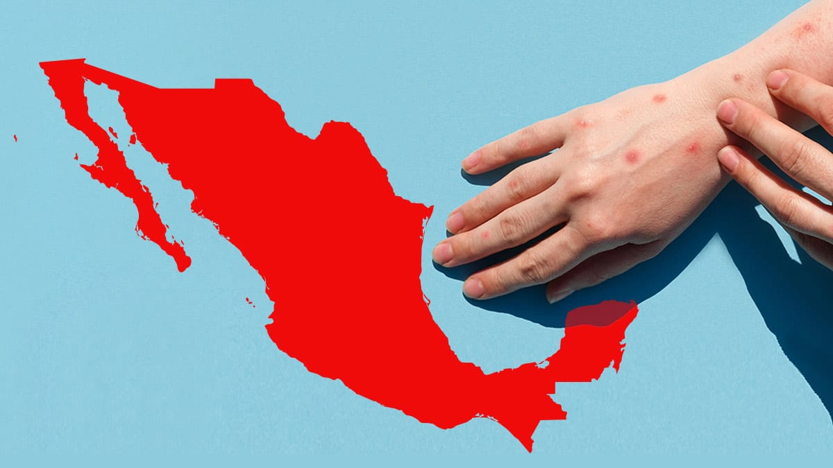 Sarampión: 217 casos en CDMX revelan un peligroso patrón de vacunación