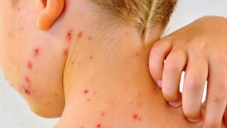 Alerta en Quintana Roo: el sarampión se dispara y regresan los filtros escolares