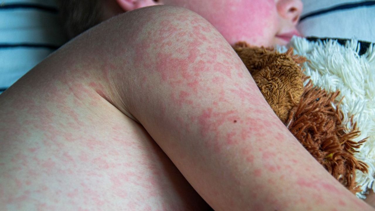Sarampión en México: Febrero 2026 marca pico histórico de contagios